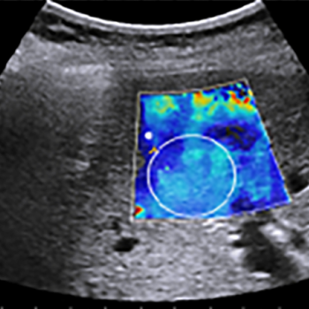 Elastography